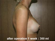 plastic-surgery-breast-augmentation 